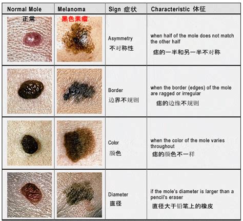 腋下有凸痣|点痣不正规可能引发癌变：关于痣的 4 个常识